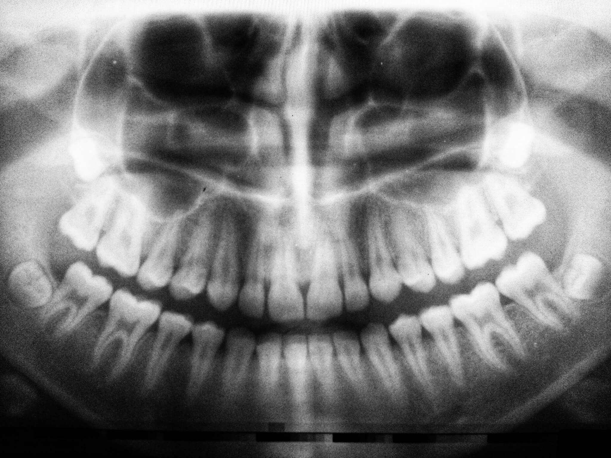 My Gums Hurt In One Spot:  What Could Be Wrong?