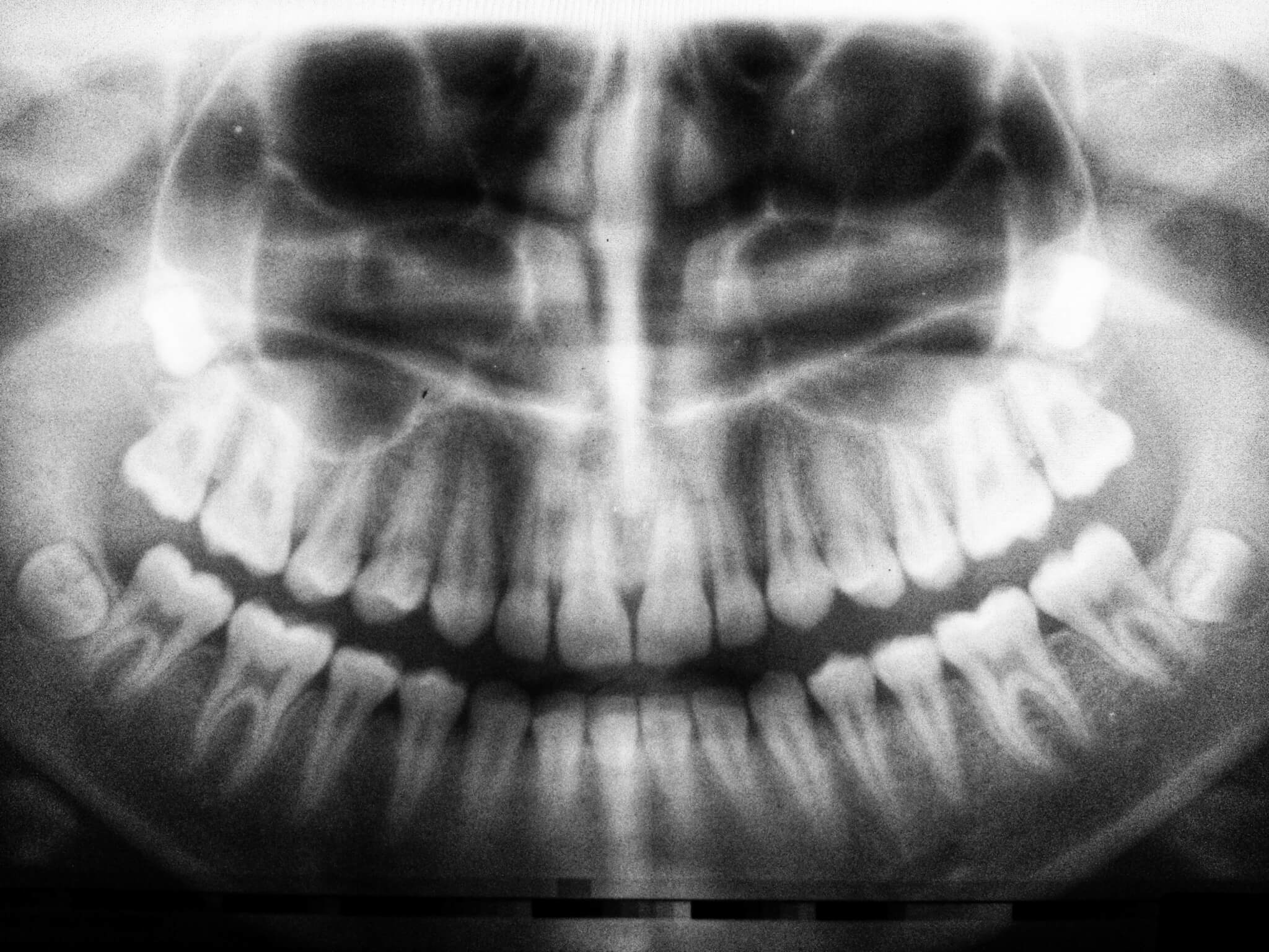 Eagle Dental Care Answers: Wisdom Teeth